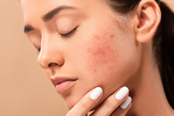 Blemishes on Face: What Are They and How To Get Rid of Them