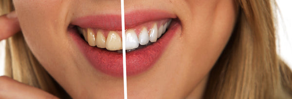 Stained Teeth - 4 DIY Ways To a Brighter Smile